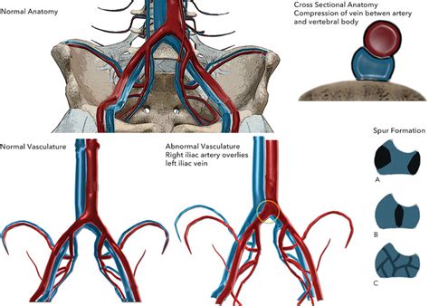 sideline iliac compression test|right common iliac vein compression.